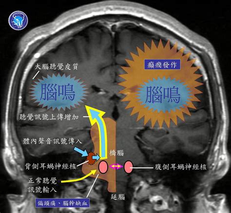 後腦沙沙聲|健康網》耳鳴、腦鳴傻傻分不清 醫教辨別細節